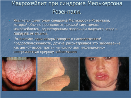 Хейлит – это воспалительное или дистрофическое заболевание губ с преимущественным поражением красной каймы губ, слайд 14