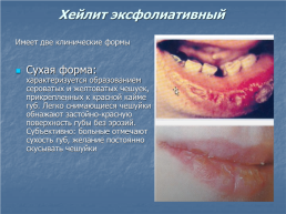 Хейлит – это воспалительное или дистрофическое заболевание губ с преимущественным поражением красной каймы губ, слайд 3
