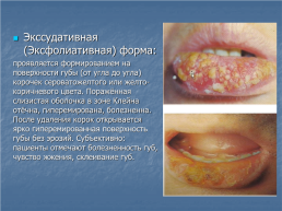 Хейлит – это воспалительное или дистрофическое заболевание губ с преимущественным поражением красной каймы губ, слайд 4