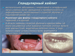 Хейлит – это воспалительное или дистрофическое заболевание губ с преимущественным поражением красной каймы губ, слайд 6