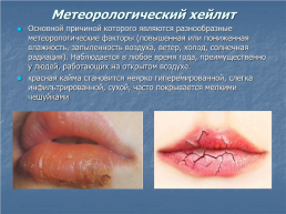 Хейлит – это воспалительное или дистрофическое заболевание губ с преимущественным поражением красной каймы губ, слайд 8