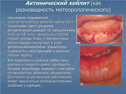 Хейлит – это воспалительное или дистрофическое заболевание губ с преимущественным поражением красной каймы губ, слайд 9