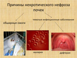 Заболевания почек, слайд 3