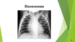 Анализ деятельности медицинской сестры в процессе реабилитации пациентов при пневмонии, слайд 4