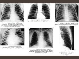 Туберкулез у детей, слайд 8